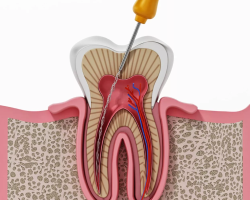 Root Canal Treatment